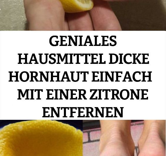 Geniales Hausmittel: Dicke Hornhaut ganz einfach mit einer Zitrone entfernen