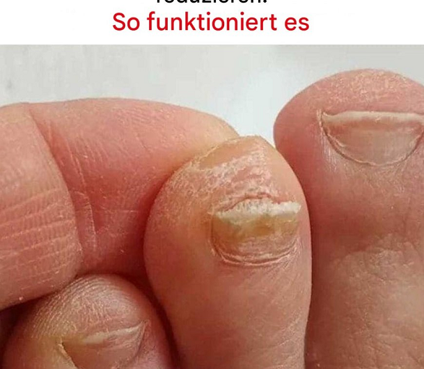 Der Trick zur Reduzierung der Zehennageldicke: Omas Hausmittel neu entdeckt