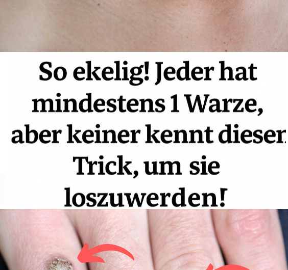 So eklig! Jeder hat mindestens 1 Warze – aber kaum jemand kennt diesen simplen Trick, um sie endlich loszuwerden!