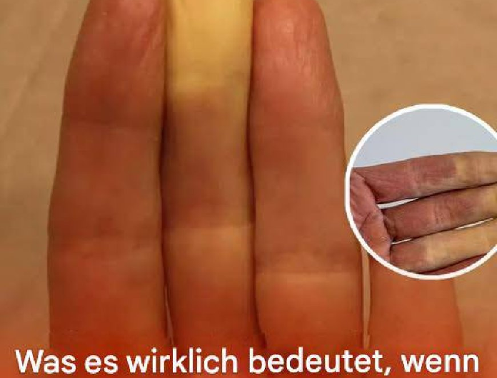 Wenn deine Finger weiß werden, wenn es kalt ist: Was wirklich dahintersteckt