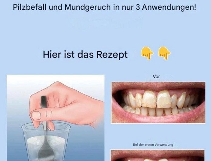 Zahnstein entfernen & Zähne natürlich aufhellen – Dieses Hausmittel wirkt besser als jede teure Behandlung!