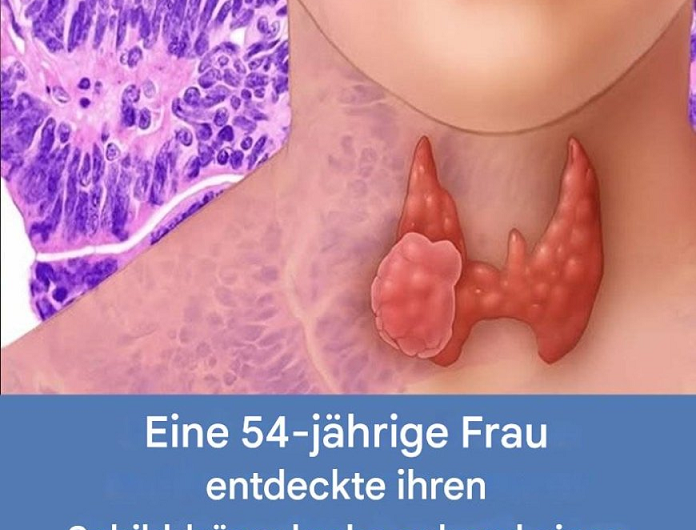 Eine 54-jährige Frau entdeckte ihren Schilddrüsenkrebs durch ein Anzeichen, das oft unbemerkt bleibt