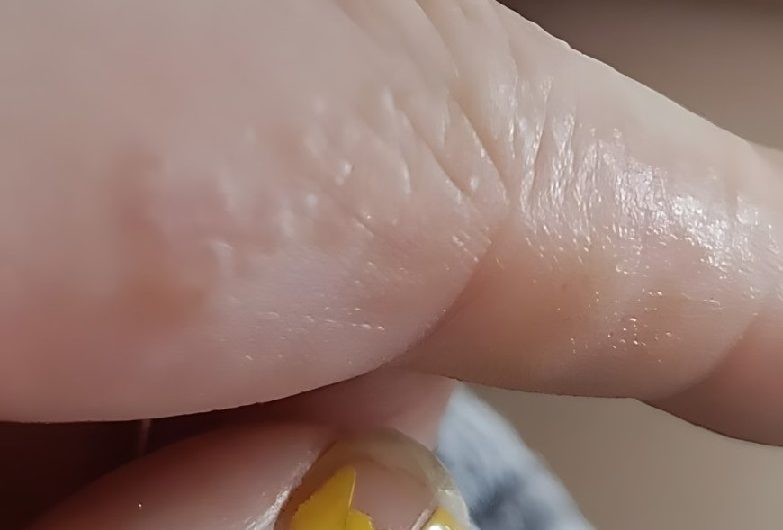 Das sind diese kleinen juckenden Beulen an deinen Fingern – wenn die Haut nicht mehr zur Ruhe kommt