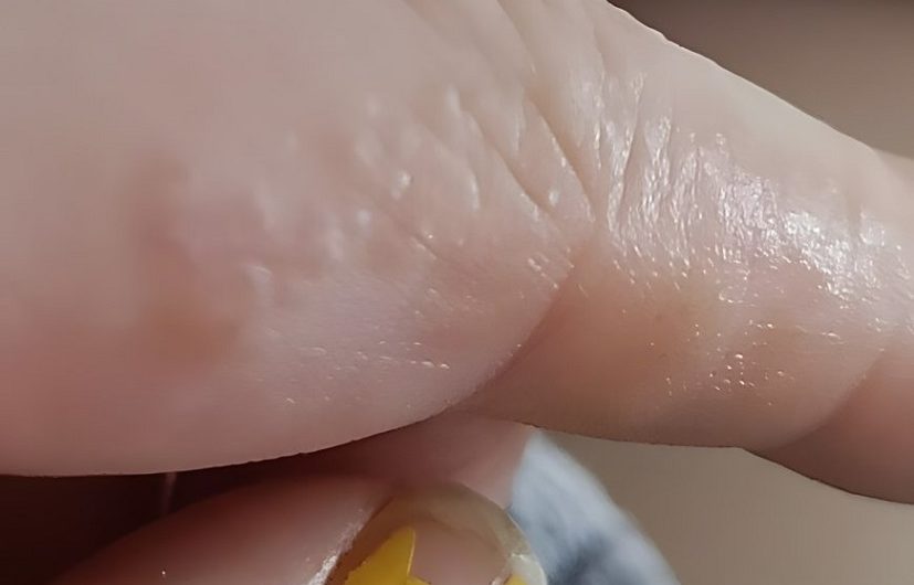 Diese winzigen Beulen an den Fingern – wie ich nach Jahren endlich verstand, was meine Hände mir sagen wollten