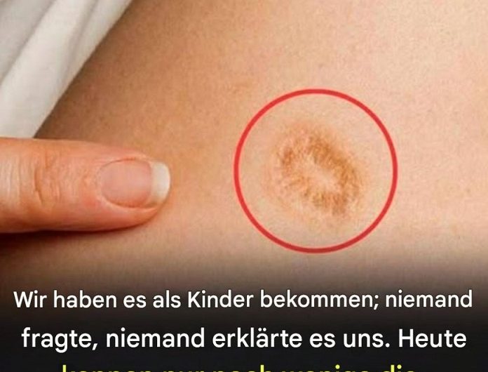 5 häufige Irrtümer über die runde Narbe am Oberarm – eine leise Geschichte, die viele von uns ein Leben lang begleiten