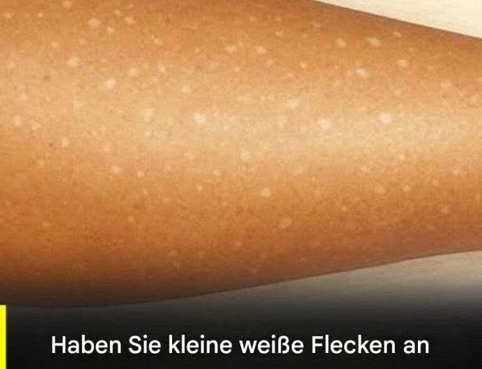 Wenn die Haut plötzlich heller wird – Was weiße Flecken bedeuten können und warum Gelassenheit oft der beste erste Schritt ist