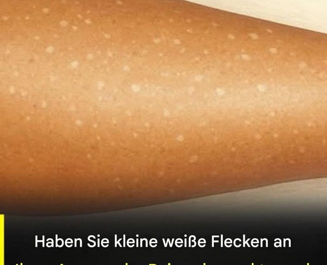 Kleine weiße Flecken auf Armen und Beinen – was wirklich dahinterstecken kann