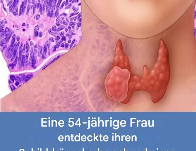 Eine 54-jährige Frau entdeckte ihren Schilddrüsenkrebs durch ein Anzeichen, das viele Menschen zunächst ignorieren