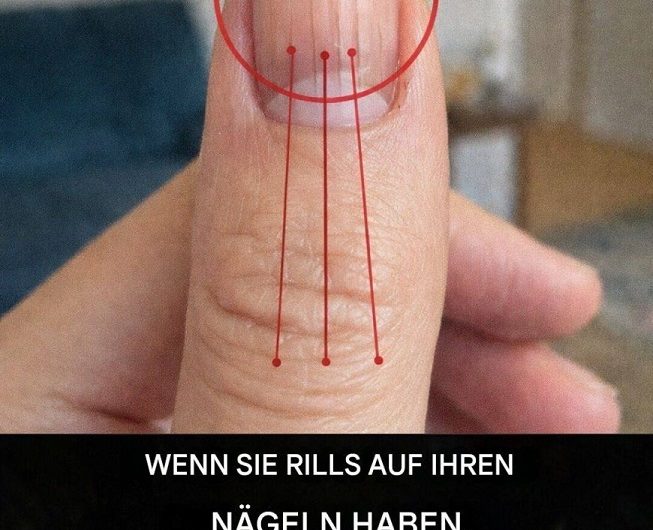 Rillen auf den Fingernägeln: Was dahinterstecken kann – und wann man genauer hinschauen sollte