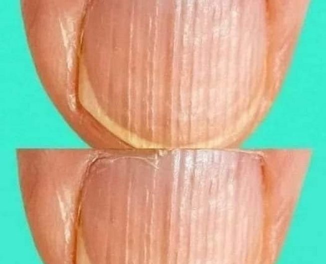 Geriffelte Fingernägel: Was Längs- und Querrillen über Ihre Gesundheit verraten können