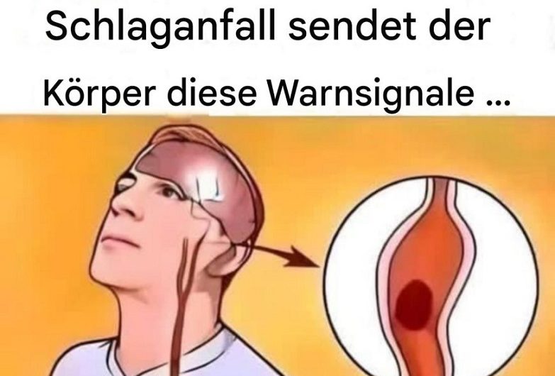 Schlaganfall-Symptome: Diese Warnzeichen sollte wirklich jeder kennen
