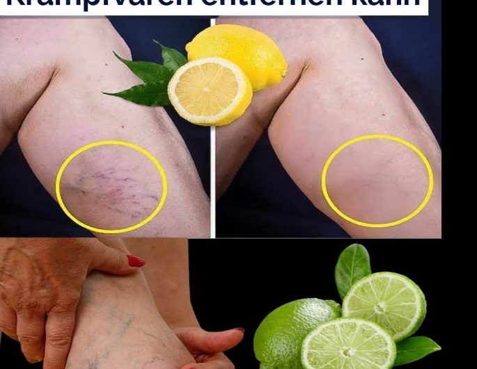 Krampfadern: Was Zitronen wirklich bewirken können – und was nicht